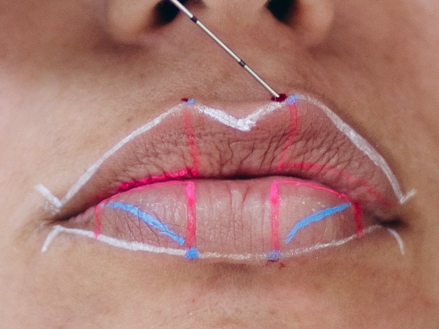 Preenchimento labial com marcações